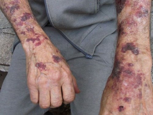 SAF sindrome anti fosfolipidio