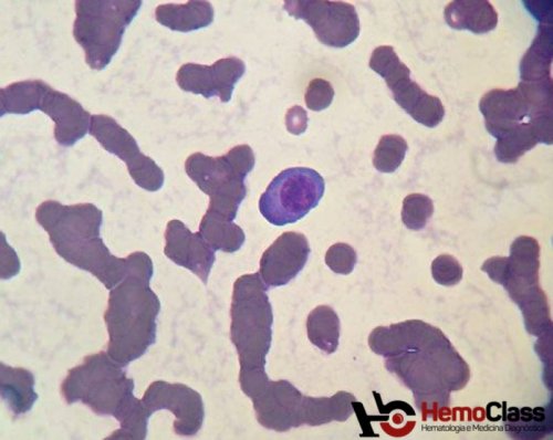 Mieloma Multiplo
