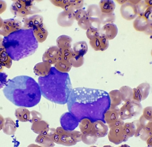 Linfoma de Burkitt em um caso clinico