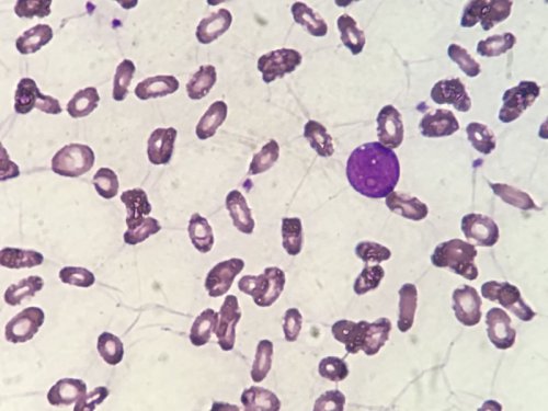 Dois problemas hematologicos em um so paciente