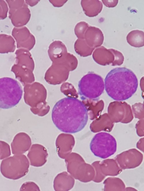 Leucemia Mieloide Aguda M2 Caso Clinico