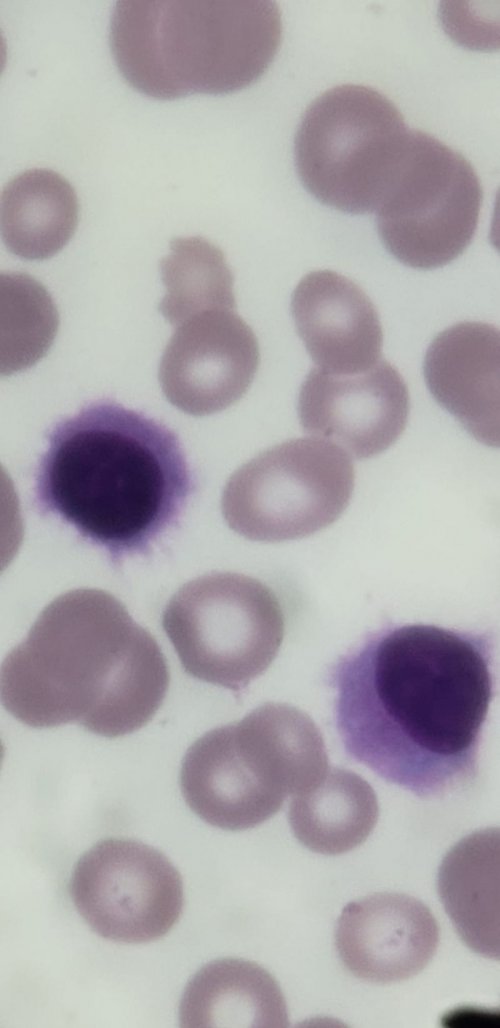 Tricoleucemia e seus achados
