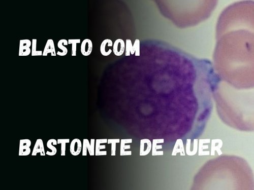 Bastonete de Auer: O Achado que Voc No Pode Ignorar no Hemograma!